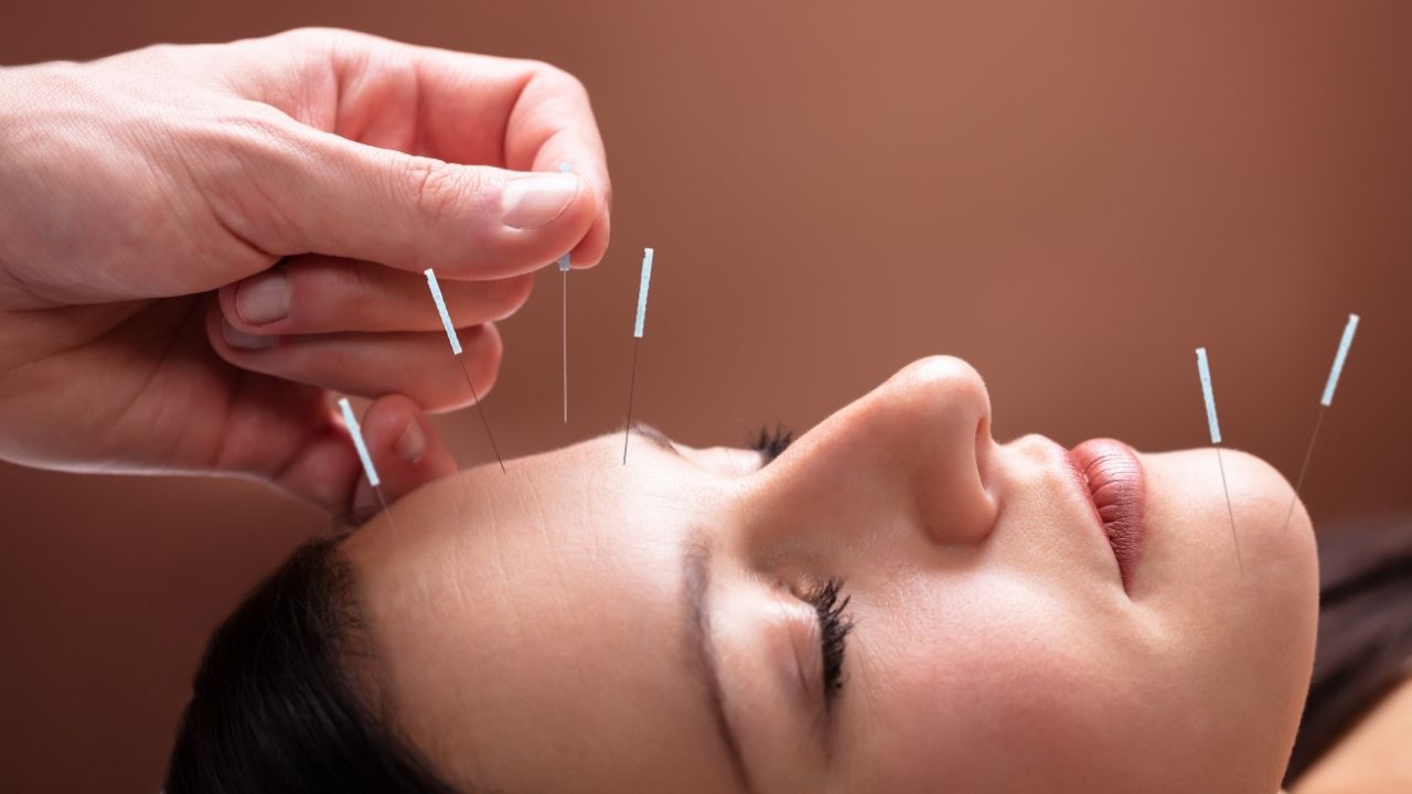 acupuncture for acne